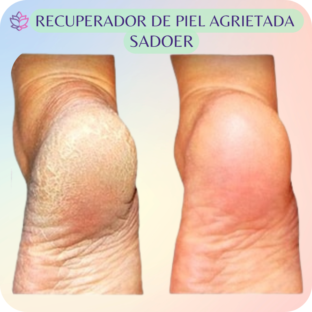 Serum Reparador UltraHidratante pies SADOER